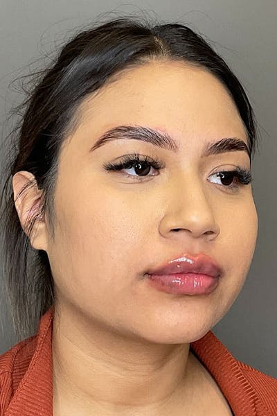 Lip Fillers Before & After Gallery - Patient 108125 - Image 6