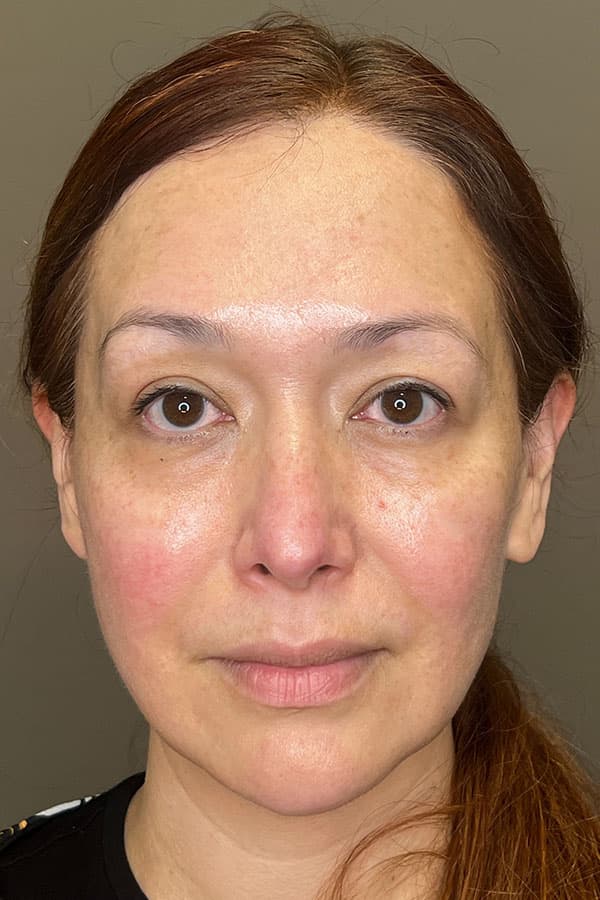 Facial Rejuvenation (Facial Balancing)  Before & After Gallery - Patient 237392 - Image 1