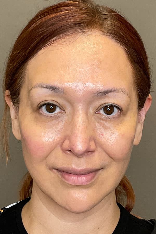 Facial Rejuvenation (Facial Balancing)  Before & After Gallery - Patient 237392 - Image 2