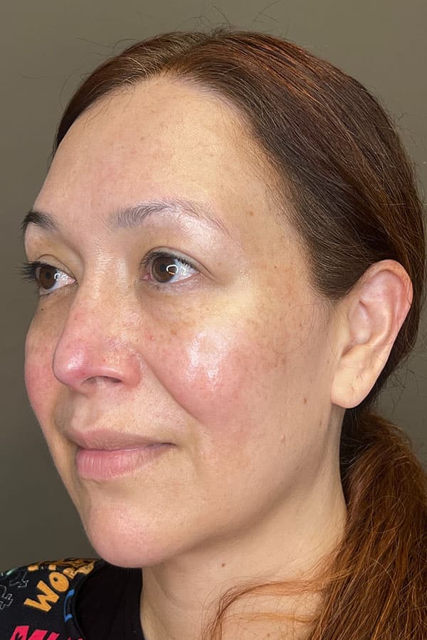 Facial Rejuvenation (Facial Balancing)  Before & After Gallery - Patient 237392 - Image 3
