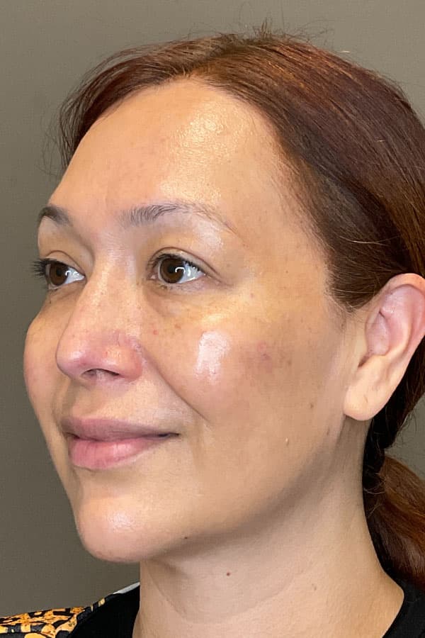 Facial Rejuvenation (Facial Balancing)  Before & After Gallery - Patient 237392 - Image 4