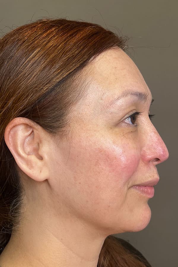 Facial Rejuvenation (Facial Balancing)  Before & After Gallery - Patient 237392 - Image 5