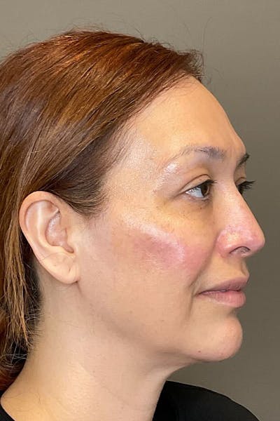 Facial Rejuvenation (Facial Balancing)  Before & After Gallery - Patient 237392 - Image 6