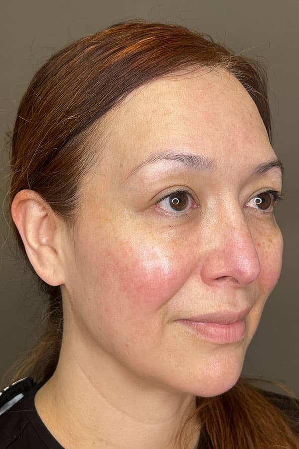 Facial Rejuvenation (Facial Balancing)  Before & After Gallery - Patient 237392 - Image 7