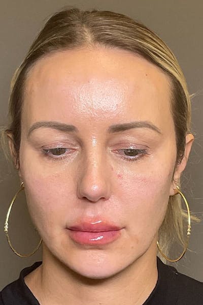Facial Rejuvenation (Facial Balancing)  Before & After Gallery - Patient 372522 - Image 4
