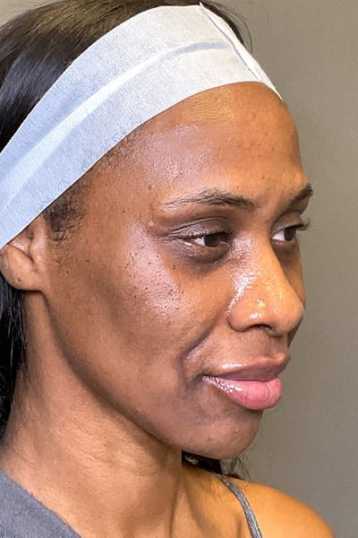 Facial Rejuvenation (Facial Balancing)  Before & After Gallery - Patient 417391 - Image 6