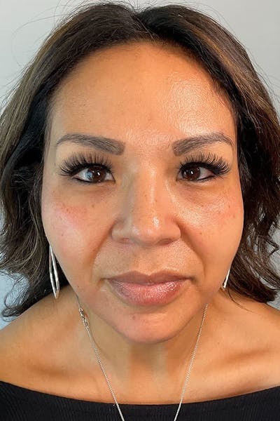 Sculptra Before & After Gallery - Patient 367753 - Image 1