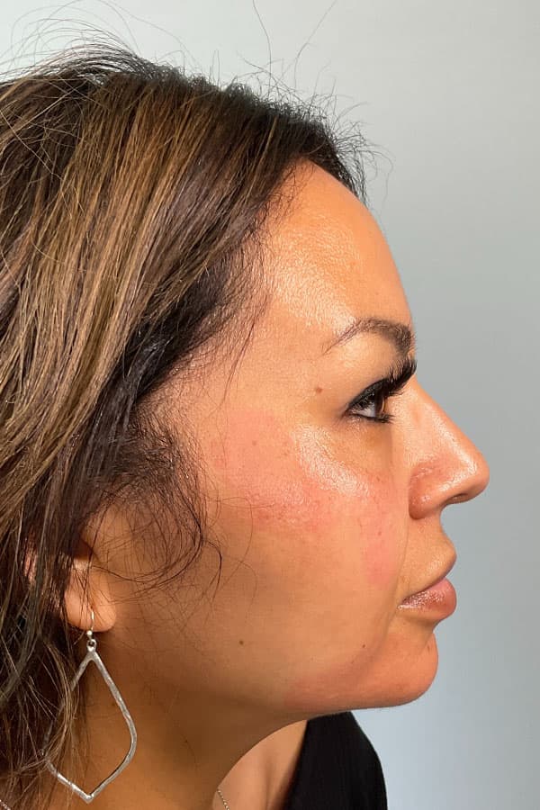 Sculptra Before & After Gallery - Patient 367753 - Image 7