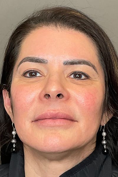 Facial Rejuvenation (Facial Balancing)  Before & After Gallery - Patient 412975 - Image 1