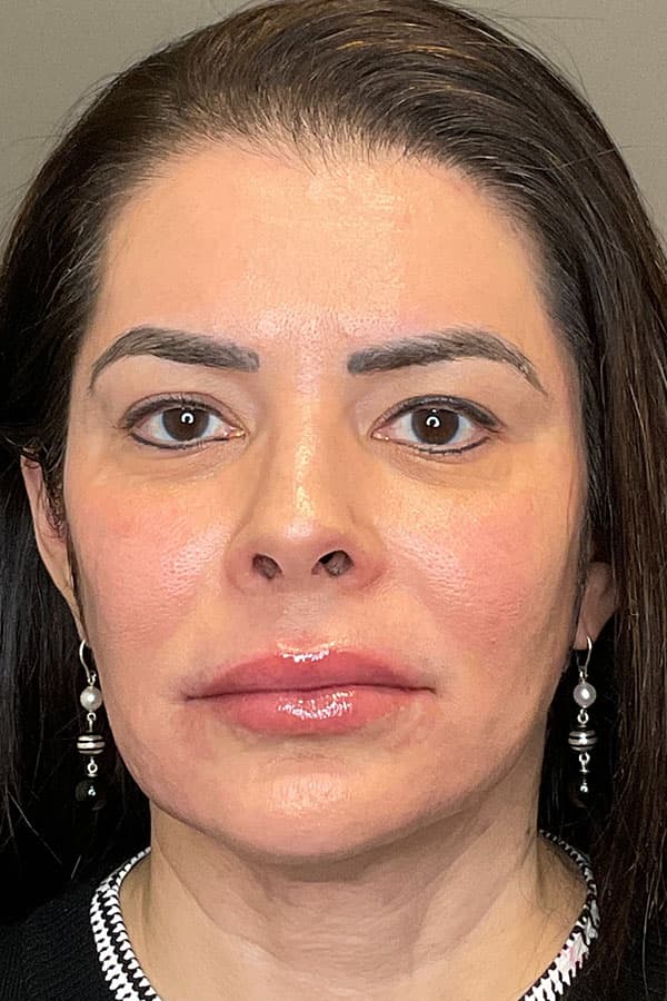 Facial Rejuvenation (Facial Balancing)  Before & After Gallery - Patient 412975 - Image 2
