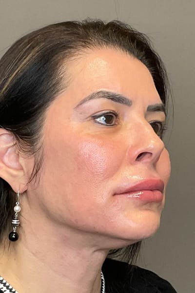 Facial Rejuvenation (Facial Balancing)  Before & After Gallery - Patient 412975 - Image 4