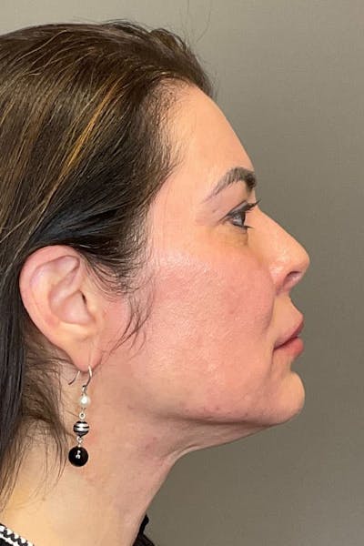 Facial Rejuvenation (Facial Balancing)  Before & After Gallery - Patient 412975 - Image 6