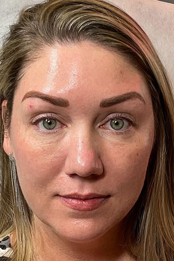 BOTOX Before & After Gallery - Patient 335716 - Image 2