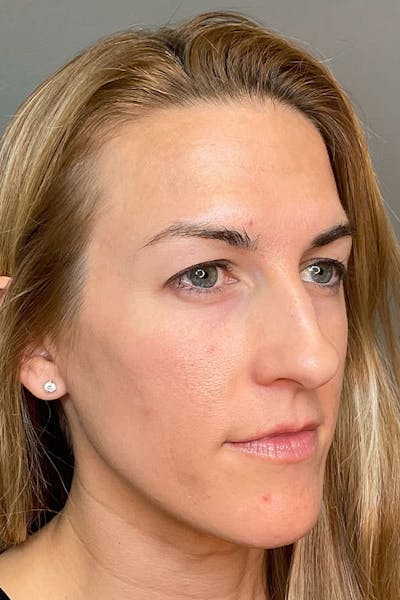 Hydrafacial Before & After Gallery - Patient 985546 - Image 2