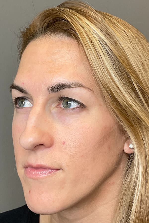 Hydrafacial Before & After Gallery - Patient 985546 - Image 4