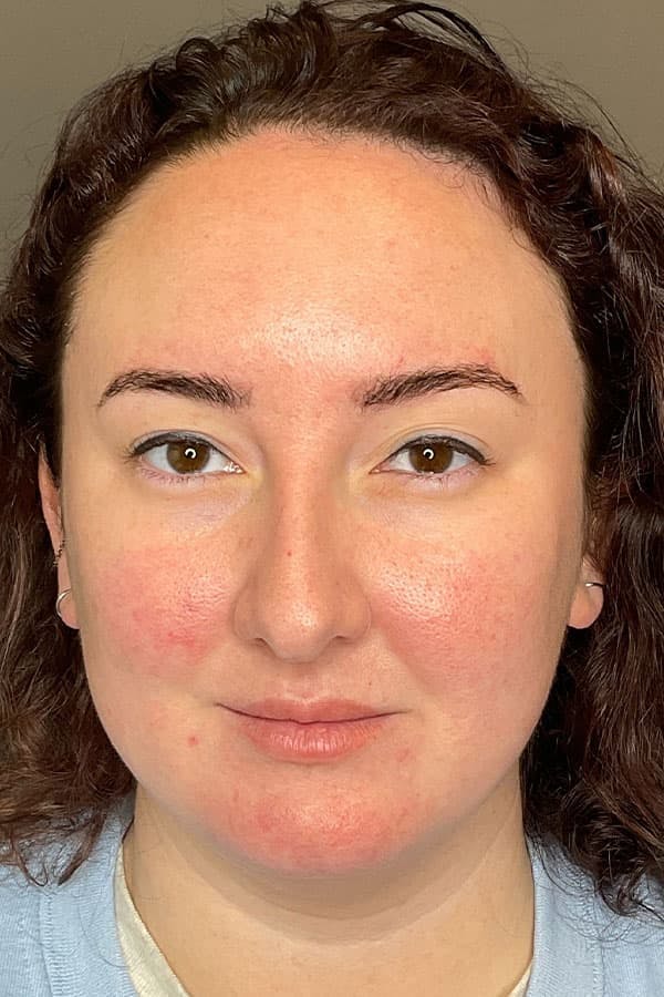 Laser Skin Resufacing Before & After Gallery - Patient 459977 - Image 2