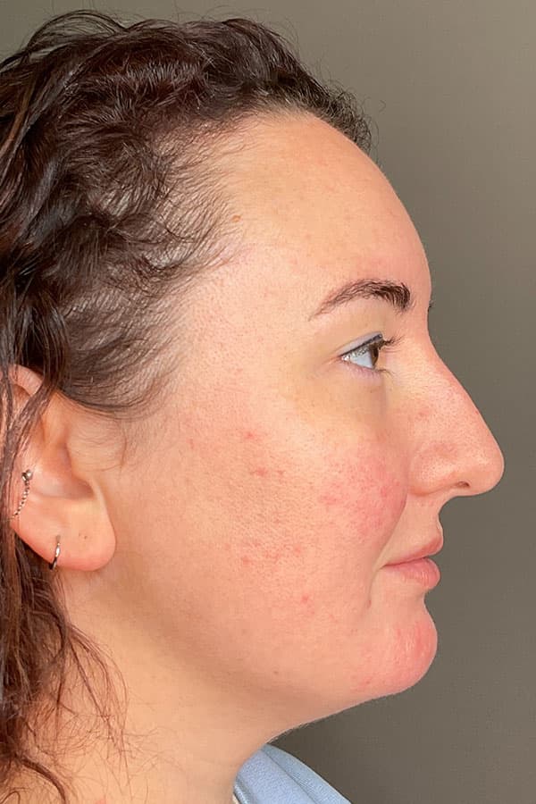 Hydrafacial Before & After Gallery - Patient 364416 - Image 4