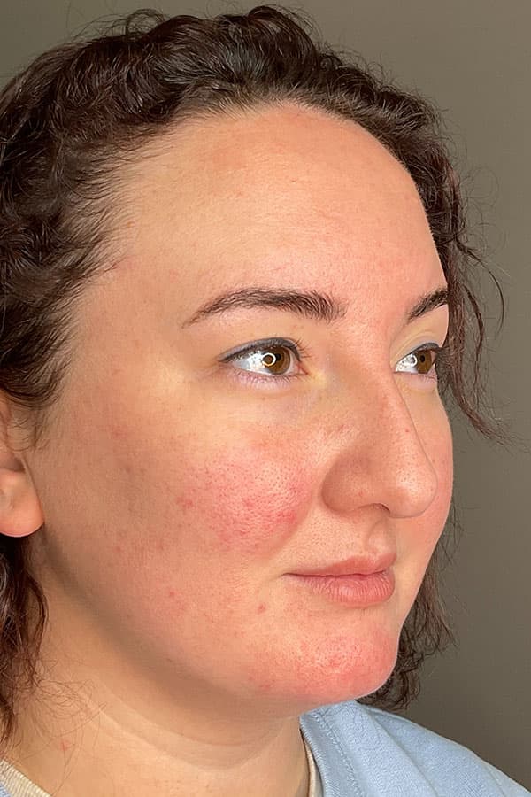 Laser Skin Resufacing Before & After Gallery - Patient 459977 - Image 6