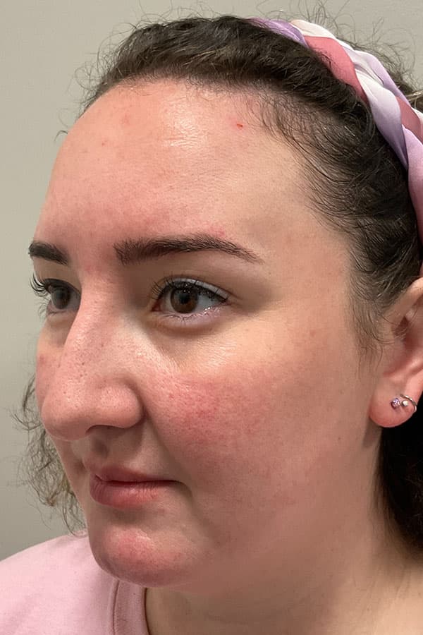 Laser Skin Resufacing Before & After Gallery - Patient 459977 - Image 7