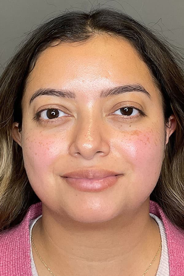 Hydrafacial Before & After Gallery - Patient 182992 - Image 2