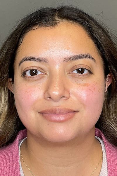 Hydrafacial Before & After Gallery - Patient 182992 - Image 2