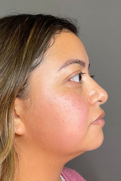 Hydrafacial Before & After Gallery - Patient 182992 - Image 4