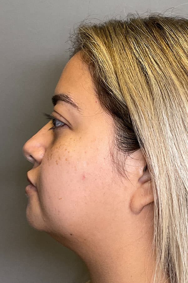 Hydrafacial Before & After Gallery - Patient 182992 - Image 5