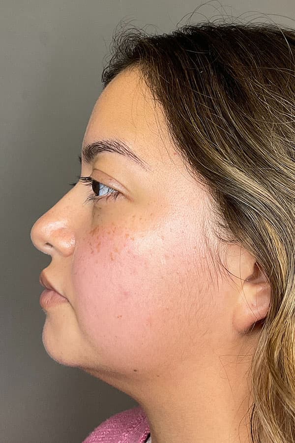 Hydrafacial Before & After Gallery - Patient 182992 - Image 6