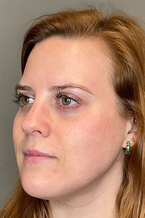 Hydrafacial Before & After Gallery - Patient 487667 - Image 4