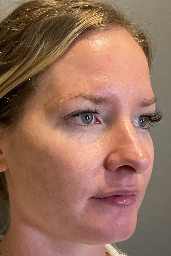 Laser Skin Resufacing Before & After Gallery - Patient 183349 - Image 6