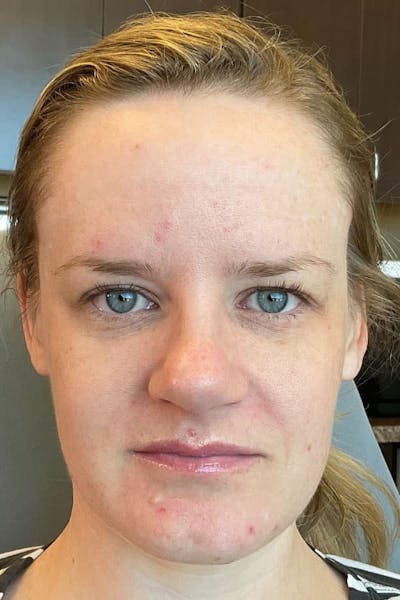 Laser Skin Resufacing Before & After Gallery - Patient 146298 - Image 1