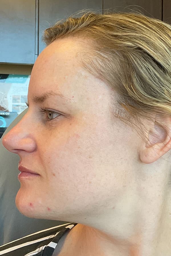 Laser Skin Resufacing Before & After Gallery - Patient 146298 - Image 3