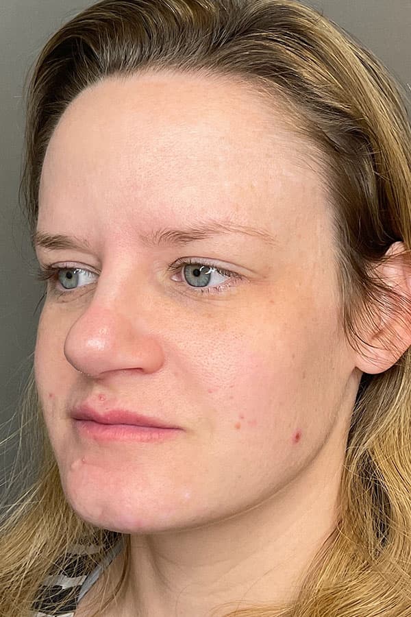 Laser Skin Resufacing Before & After Gallery - Patient 146298 - Image 4