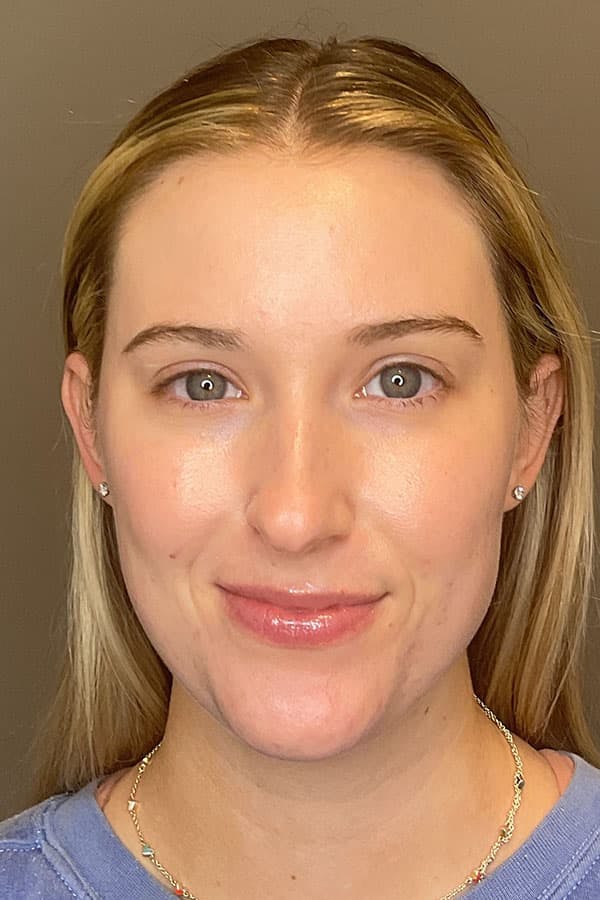 Hydrafacial Before & After Gallery - Patient 376880 - Image 2