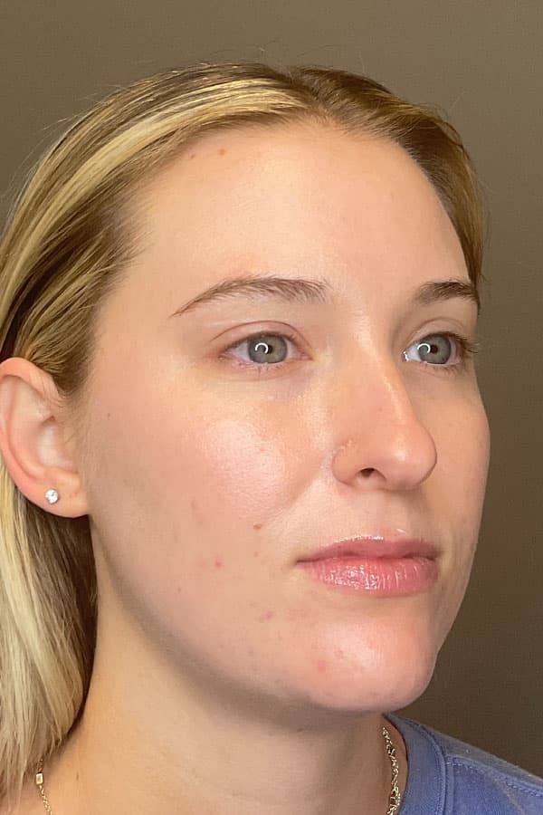 Hydrafacial Before & After Gallery - Patient 376880 - Image 4