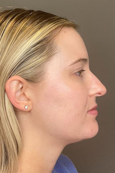 Hydrafacial Before & After Gallery - Patient 376880 - Image 6