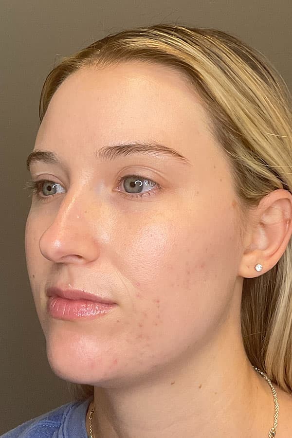 Hydrafacial Before & After Gallery - Patient 376880 - Image 8
