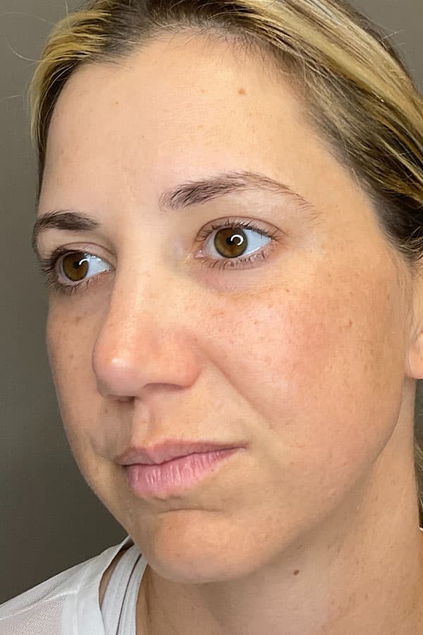 Laser Skin Resufacing Before & After Gallery - Patient 107870 - Image 4