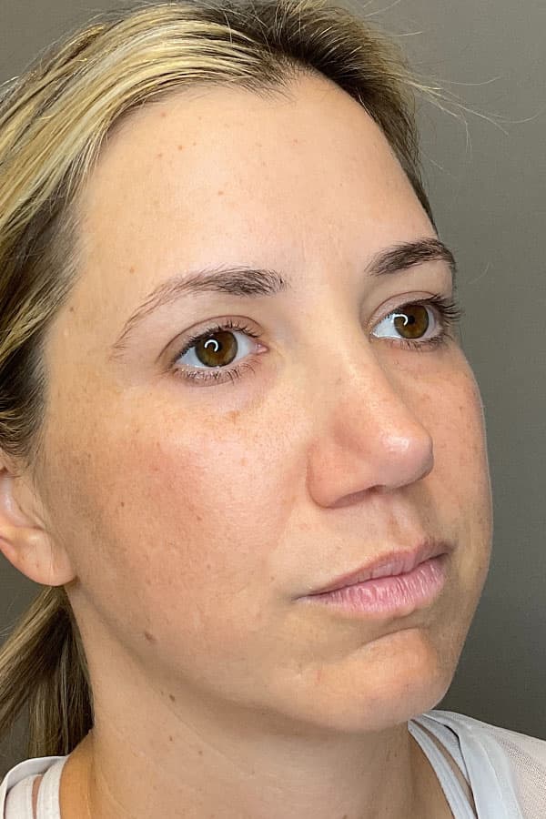Laser Skin Resufacing Before & After Gallery - Patient 107870 - Image 6
