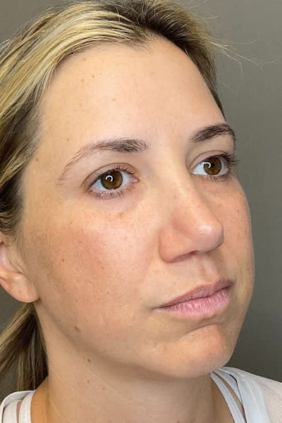 Laser Skin Resufacing Before & After Gallery - Patient 107870 - Image 6