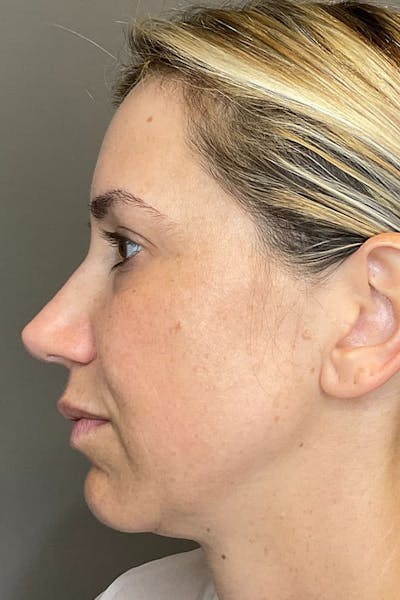 Laser Skin Resufacing Before & After Gallery - Patient 107870 - Image 8
