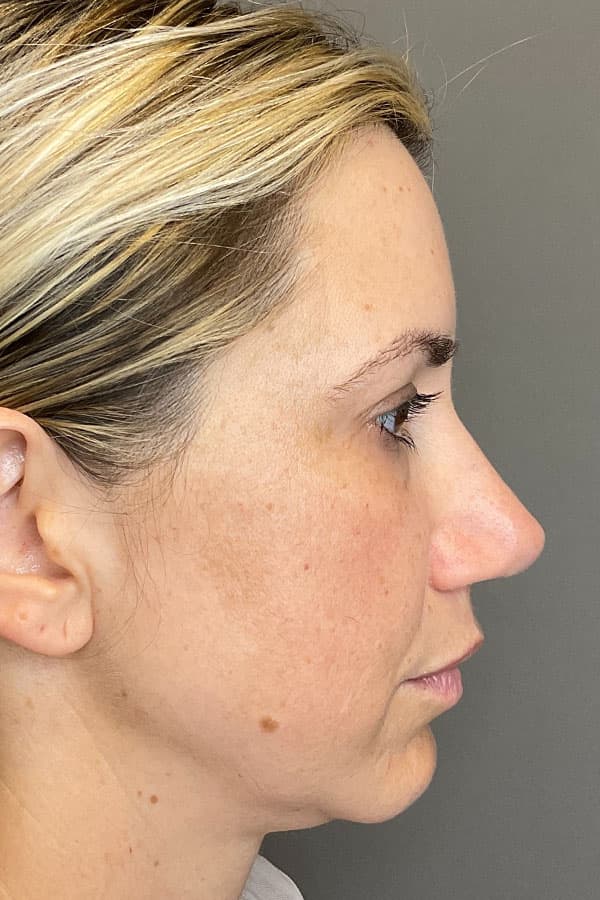 Laser Skin Resufacing Before & After Gallery - Patient 107870 - Image 10