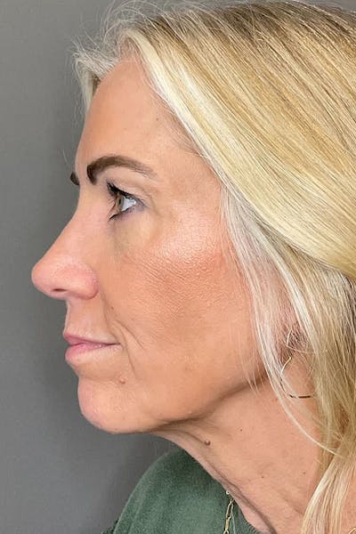 Laser Skin Resufacing Before & After Gallery - Patient 293464 - Image 4