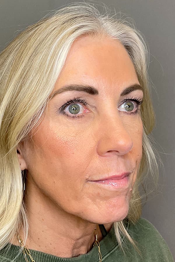 Laser Skin Resufacing Before & After Gallery - Patient 293464 - Image 6