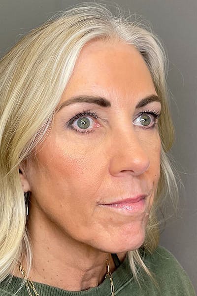 Laser Skin Resufacing Before & After Gallery - Patient 293464 - Image 6
