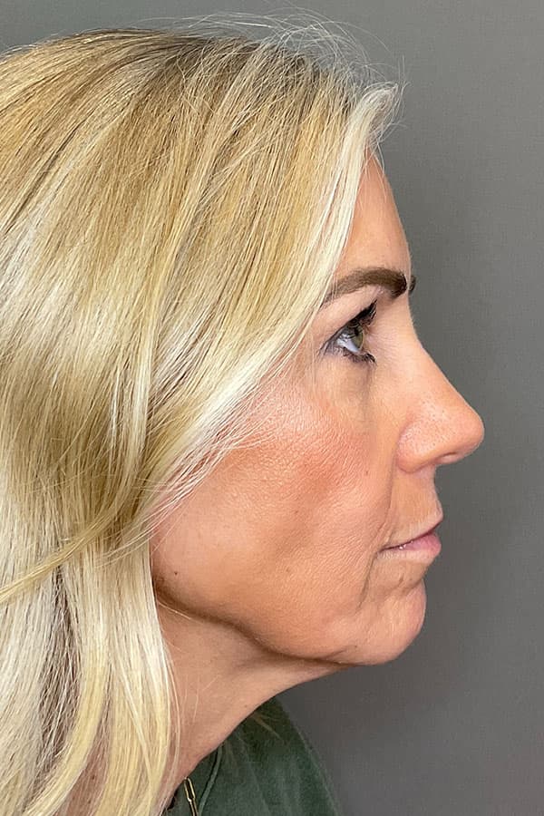 Laser Skin Resufacing Before & After Gallery - Patient 293464 - Image 8