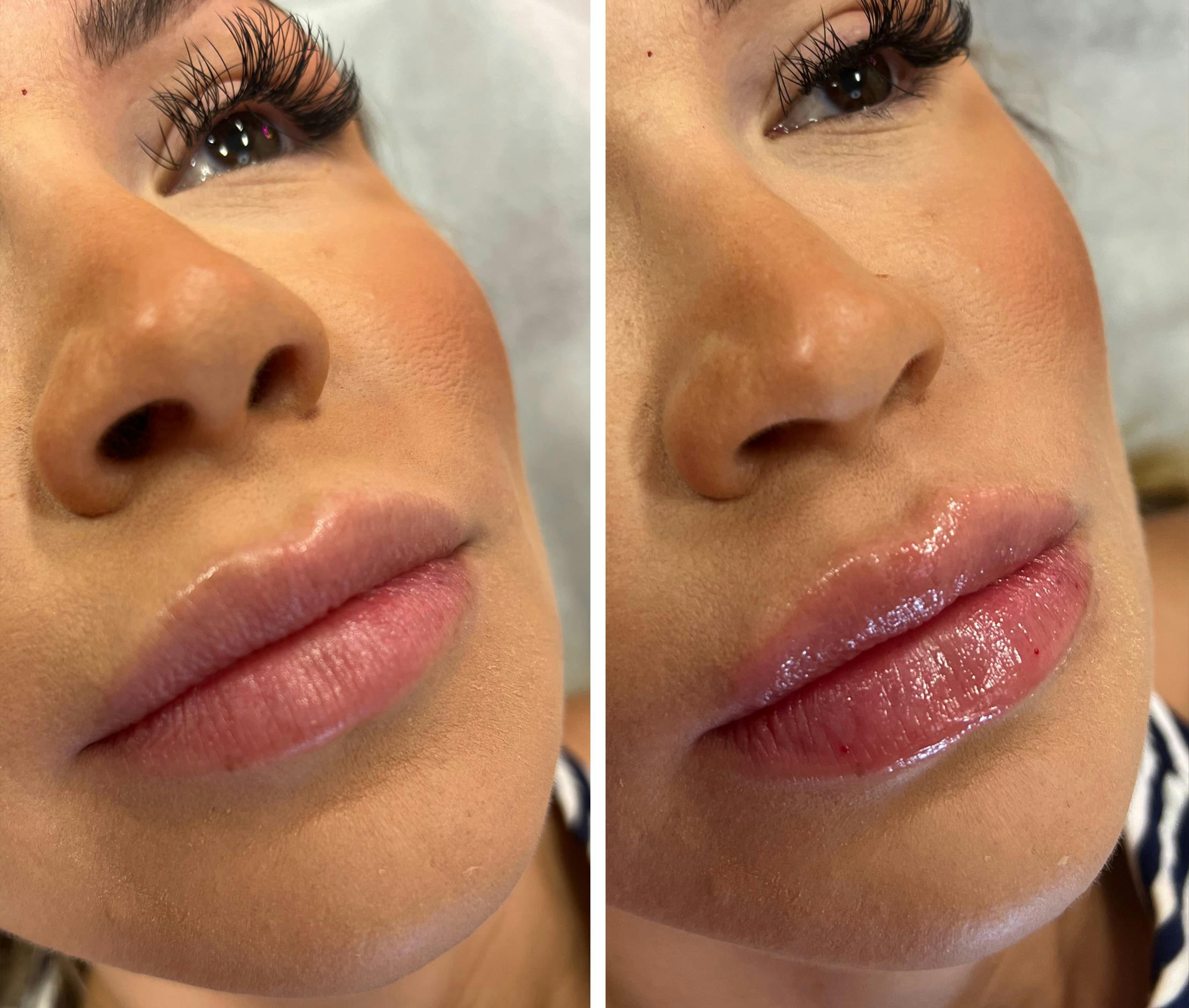 Lip Fillers Before & After Gallery - Patient 402580 - Image 1