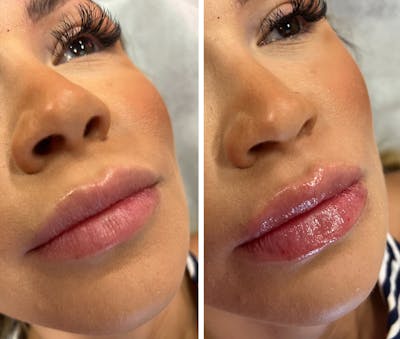 Lip Fillers Before & After Gallery - Patient 402580 - Image 1