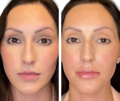 Lip Fillers Before & After Gallery - Patient 390955 - Image 1
