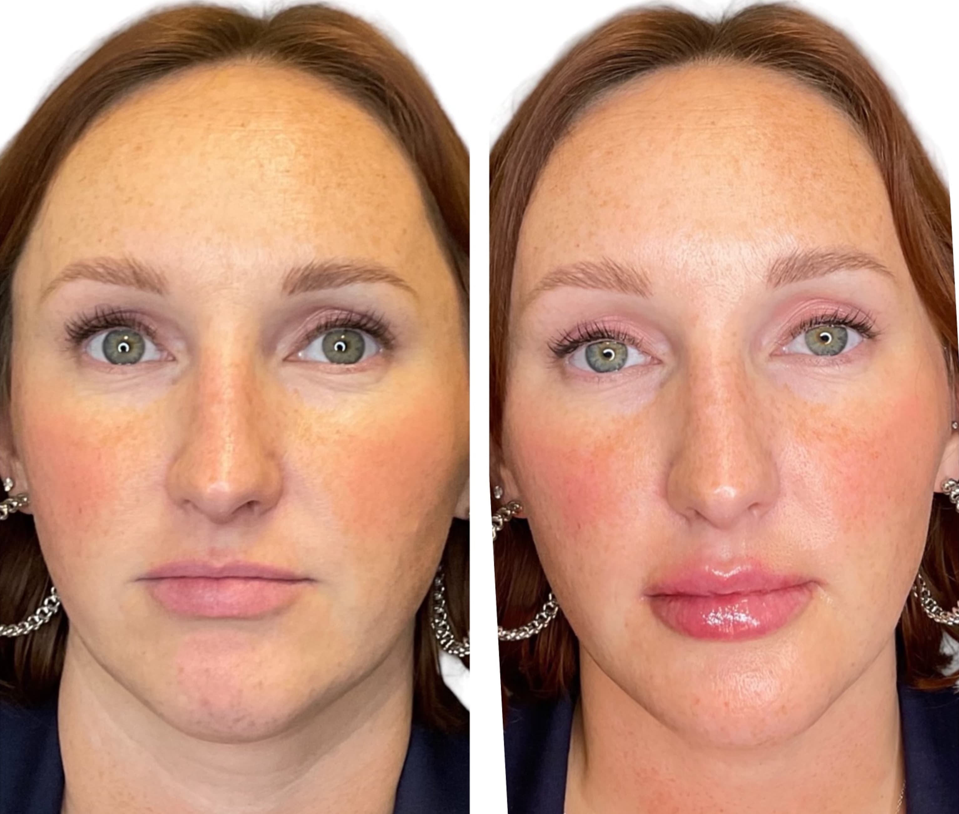 Lip Fillers Before & After Gallery - Patient 219108 - Image 1
